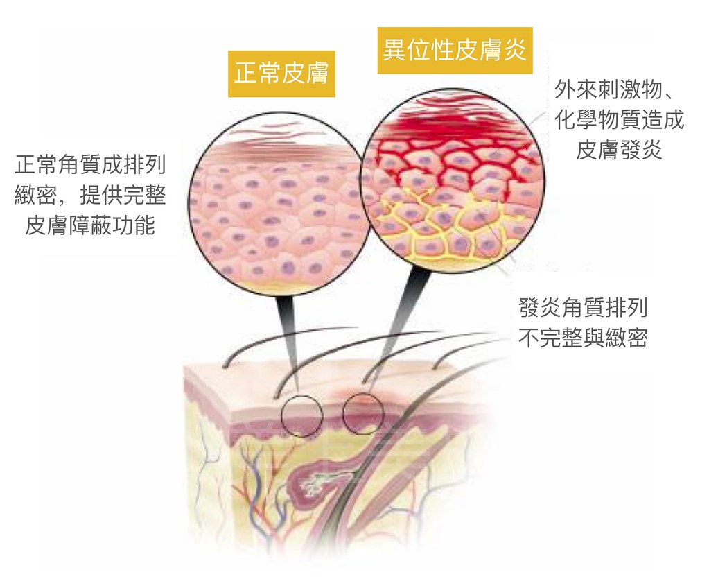 異位性皮膚炎